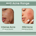 Anti Acne Range - Intense Acne To Mild Acne