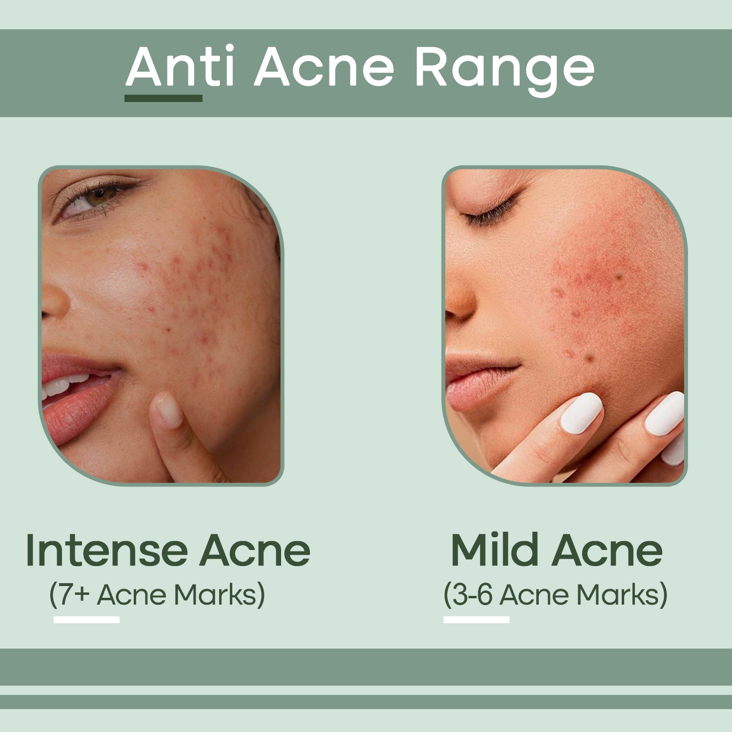 Anti Acne Range - Intense Acne to Mild Acne