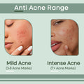 Anti Acne Range - Mild Acne to Intense Acne