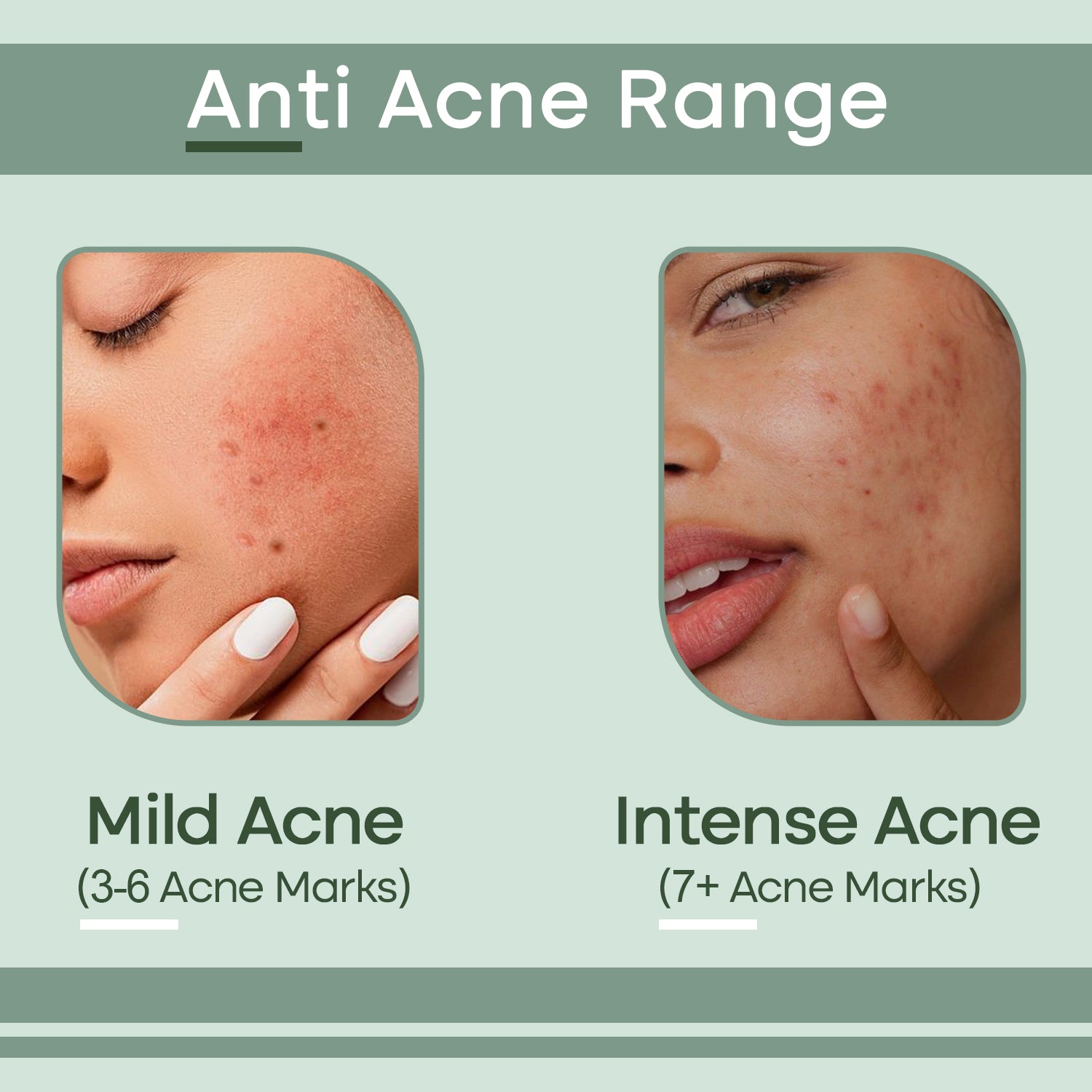 Anti Acne Range From Mild Acne to Intense Acne